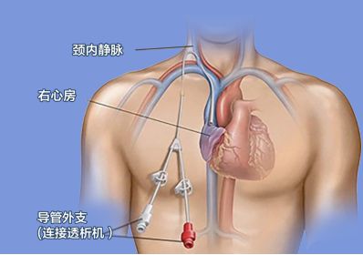 93岁高龄透析老人“最后的选择”被堵住了！多学科协作“巧思九游体育”疏通！(图1)